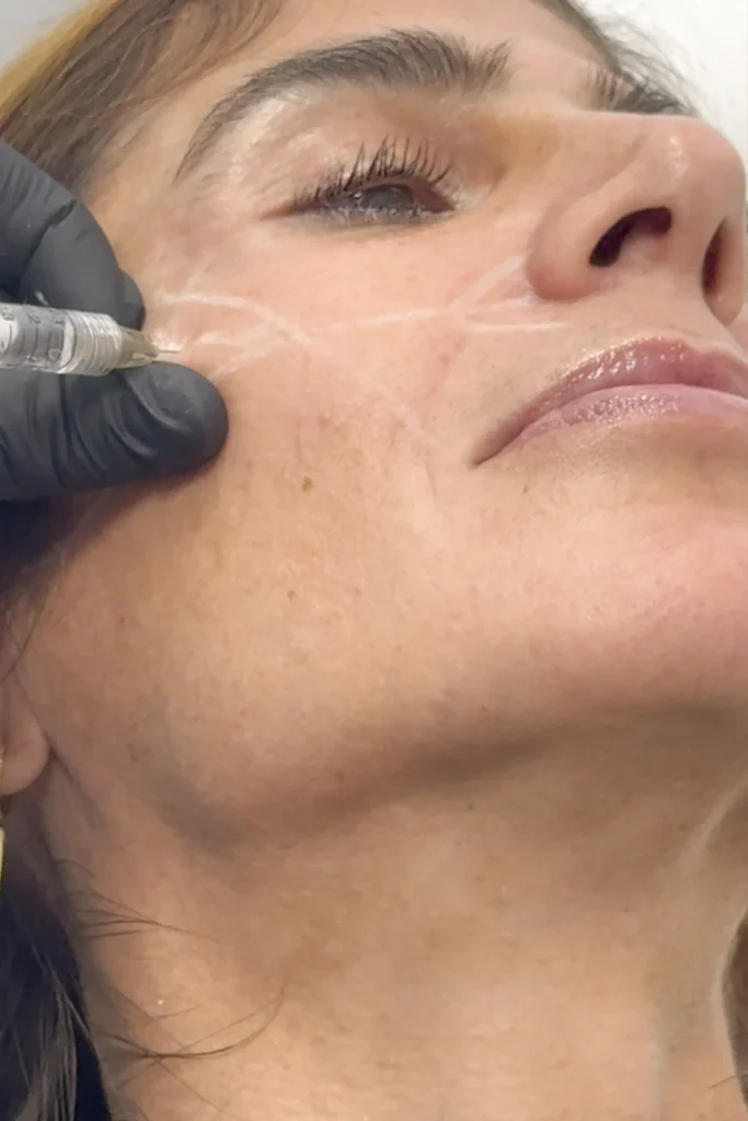 filler prima e dopo cosa devi sapere