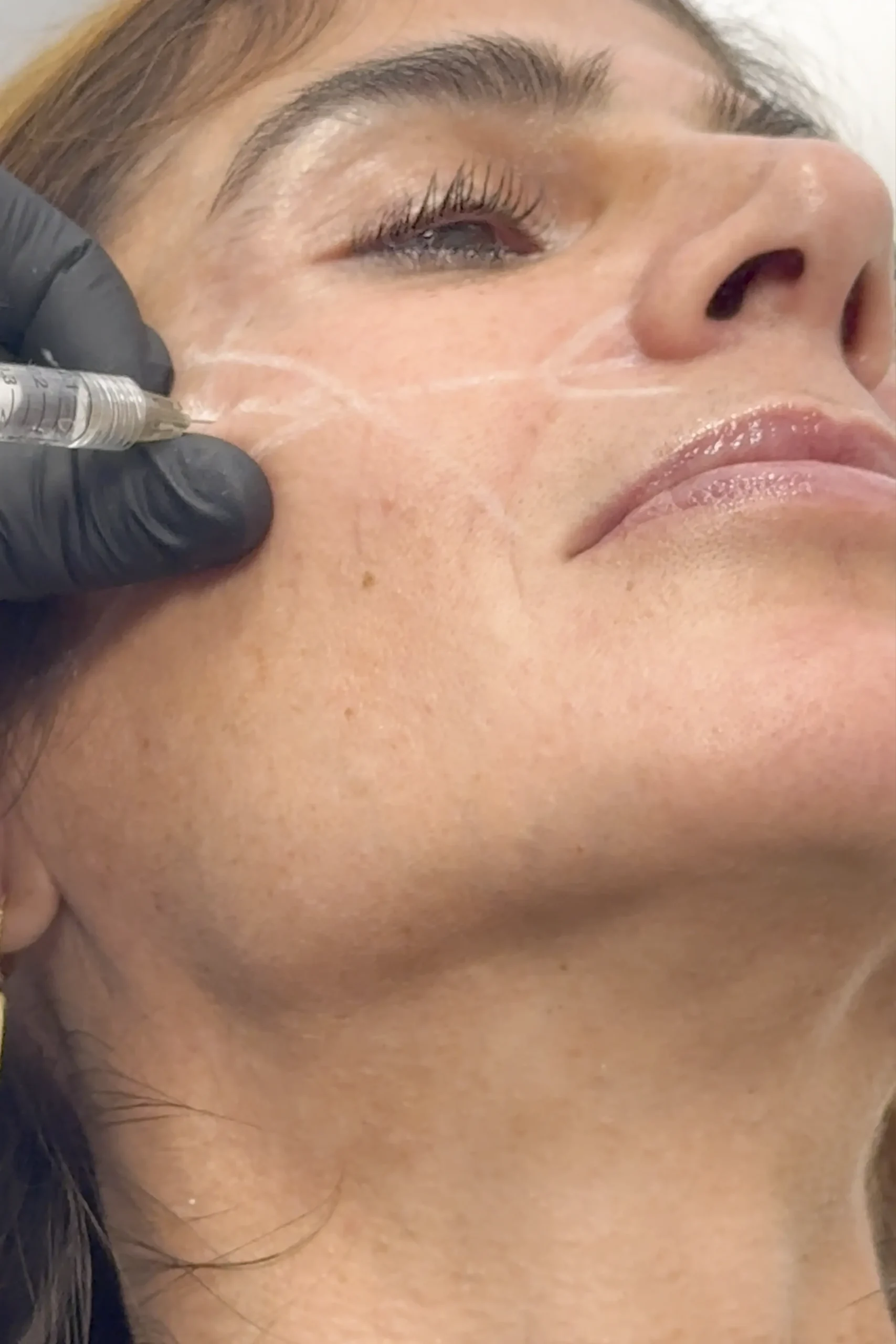 filler prima e dopo cosa devi sapere