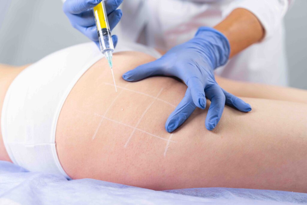 Carbossiterapia cellulite Milano