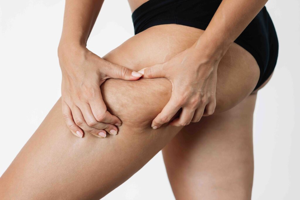 cellulite e ritenzione idrica