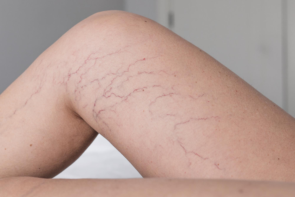 Scleroterapia Milano